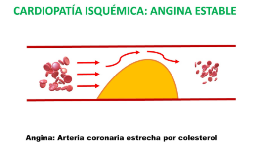 Arteria en angina estable