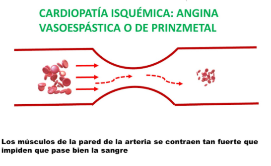 Arteria en angina de Prinzmetal