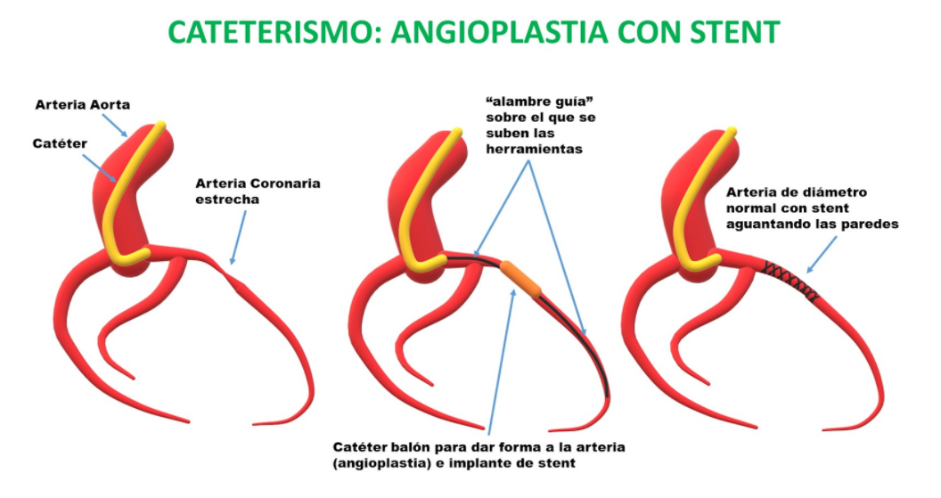 Cateterismo angioplastia con stent