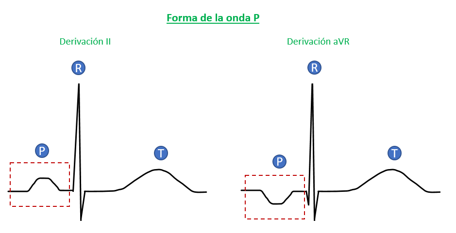 forma de la onda P en el ECG
