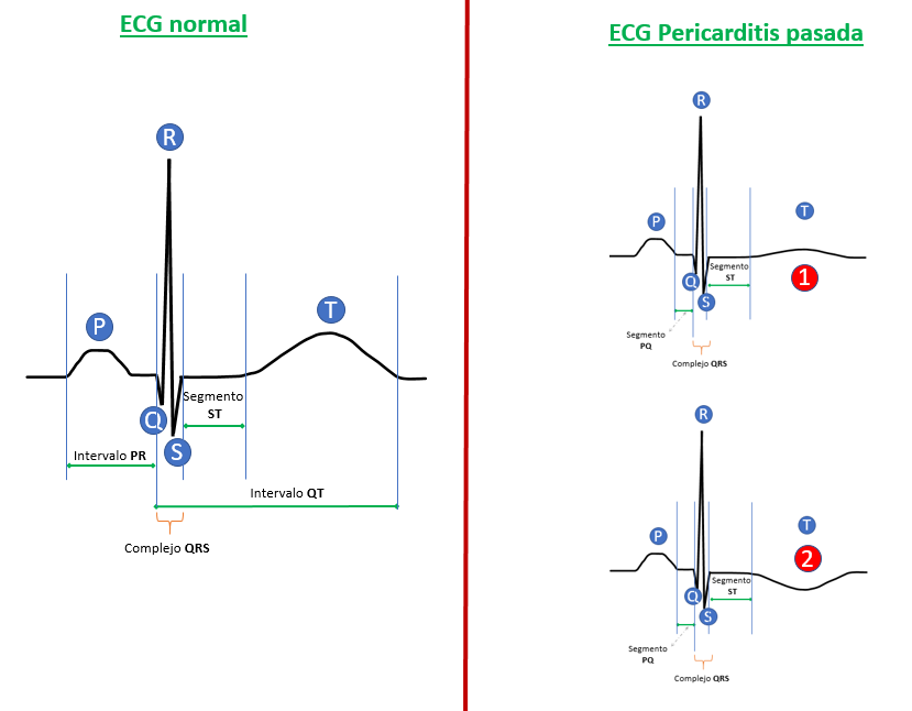 ECG de pericarditis en fase posterior