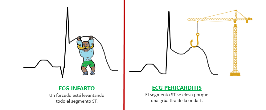 Diferencias ECG de pericarditis e infarto de miocardio
