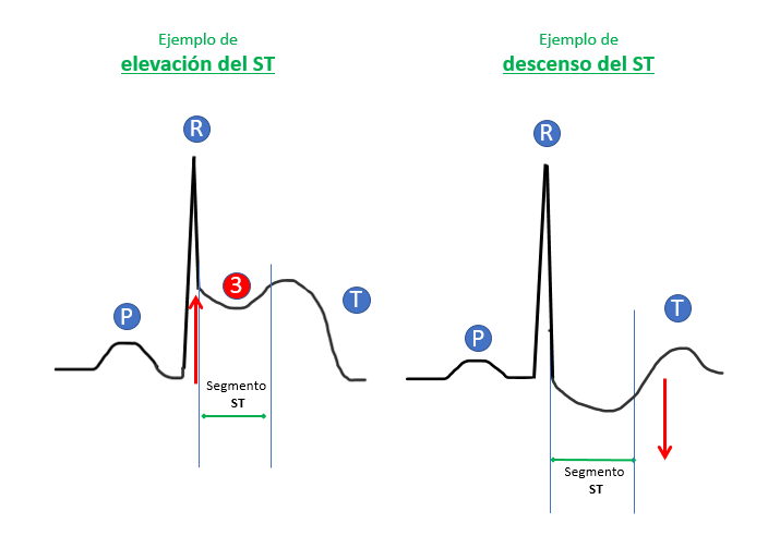 elevación del segmento ST y descenso del segmento ST en el ECG