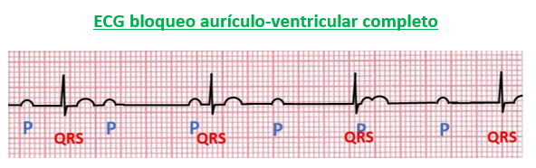 trazado ECG bloqueo aurículo ventricular completo