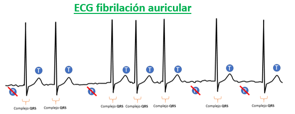 trazado ECG fibrilación auricular