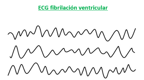 trazado ECG fibrilación ventricular