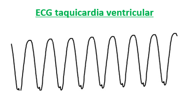 trazado ECG taquicardia ventricular