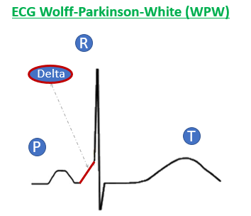 trazado ECG WPW Wolff-Parkinson-White