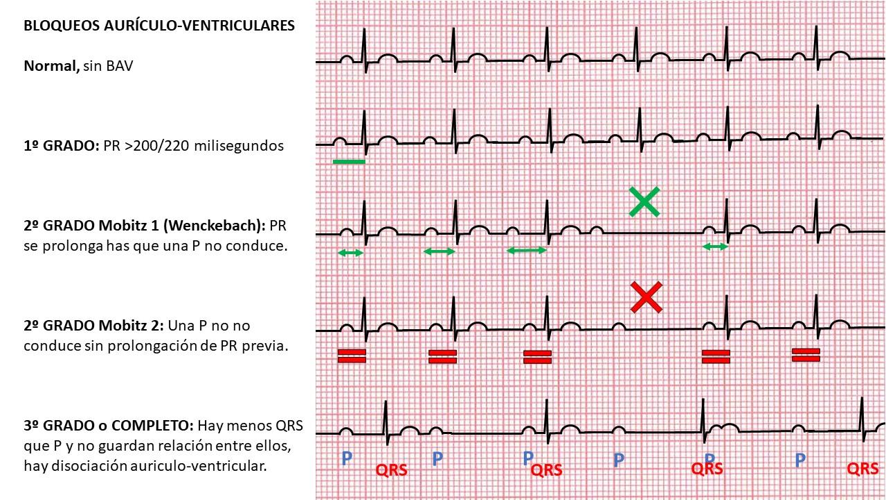 Tipos de bloqueos auriculo ventriculares en el ECG