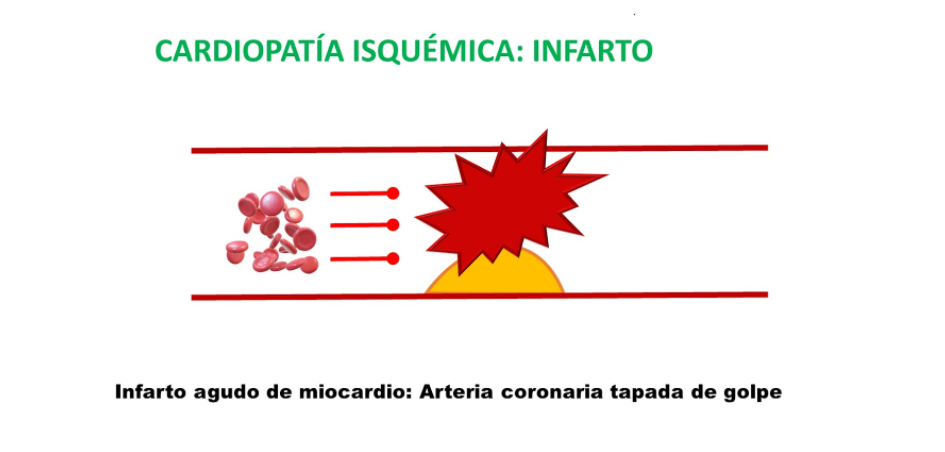 Arteria con infarto de corazón