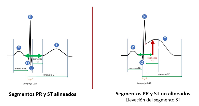 Alineación de los segmentos PR y ST en un electrocardigrama