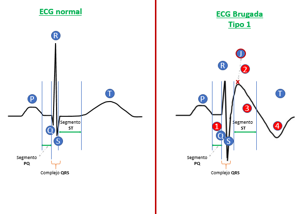 ECG de síndrome de Brugada tipo 1