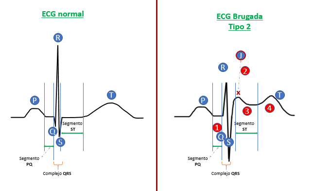 ECG de síndrome de Brugada tipo 2