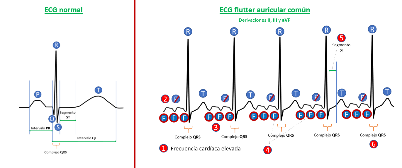 ECG flutter auricular