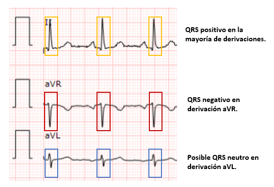 Morfologias Del Complejo Qrs En El Electrocardiograma My Xxx Hot Girl