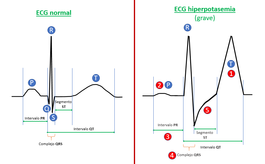 ECG hiperpotasemia grave