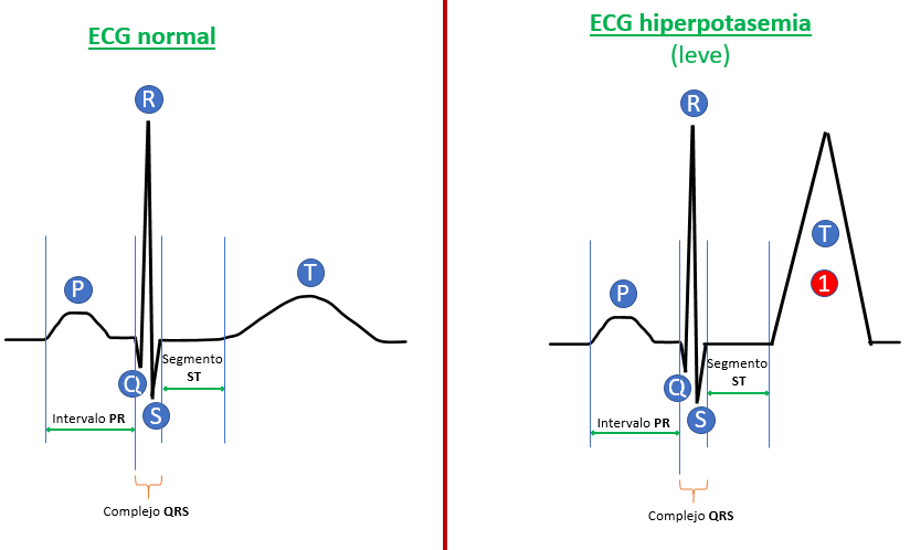 ECG hiperpotasemia leve