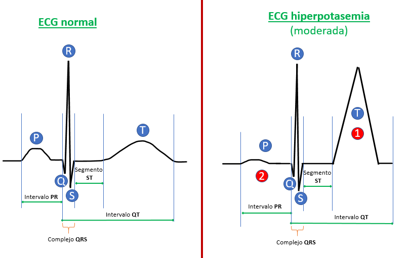 ECG hiperpotasemia moderada
