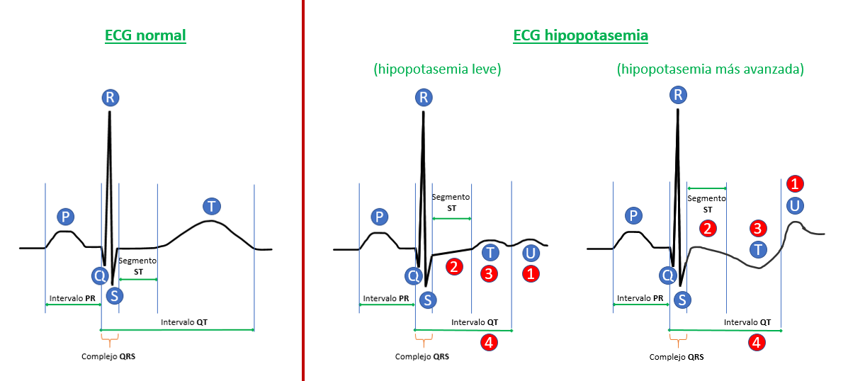 ECG hipopotasemia