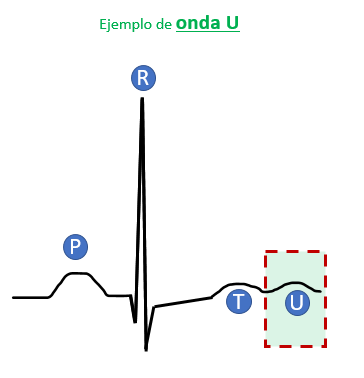 Onda U en el ECG