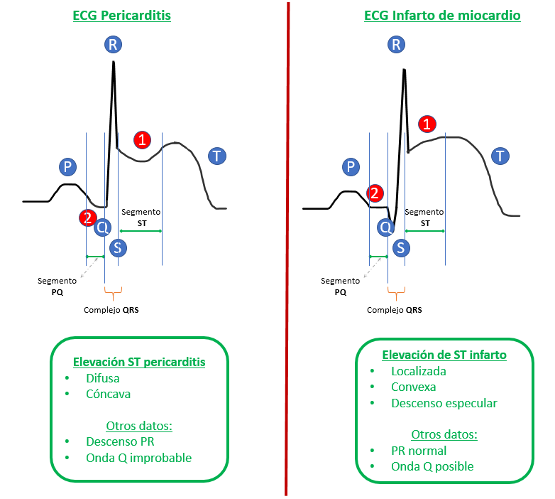 ¿cómo Identificar Pericarditis En Un Ecg Guía Sencilla