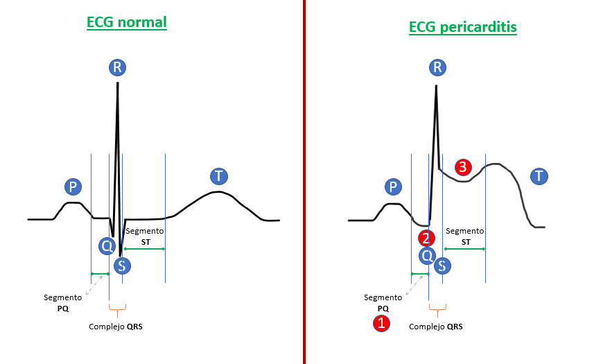 ECG de pericarditis