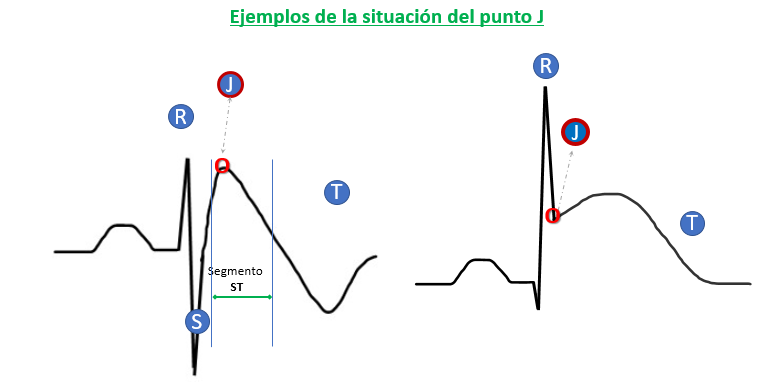 punto J en el ECG