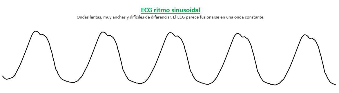 ECG ritmo sinusoidal