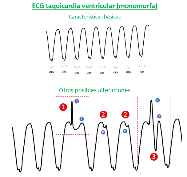 Alteraciones ECG taquicardia ventricular