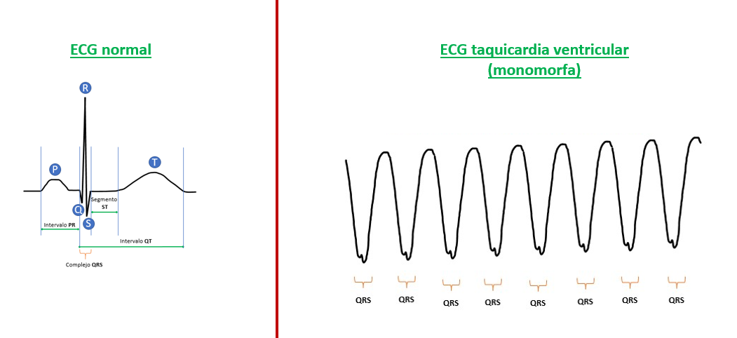 ECG taquicardia ventricular