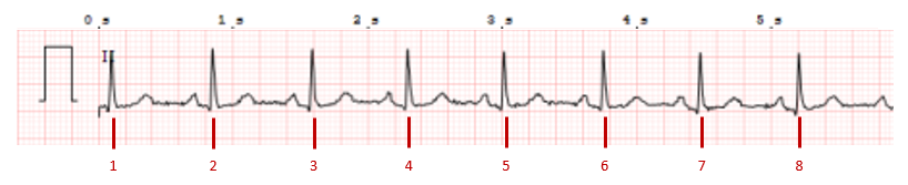 frecuencia normal en un ECG