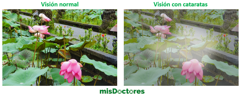 Visión normal vs visión con catarata